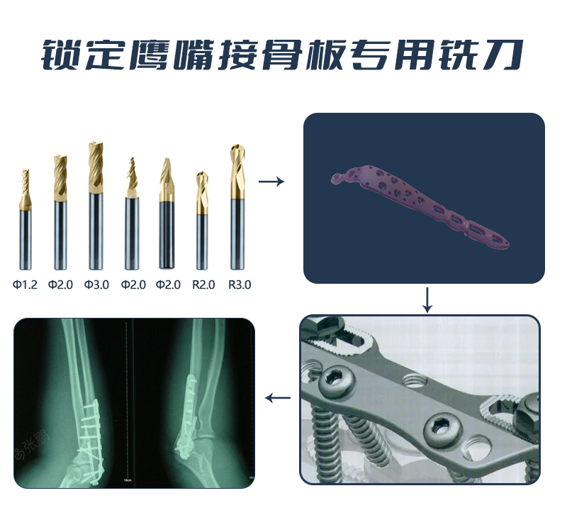 锁定鹰嘴接骨板应用 (1)