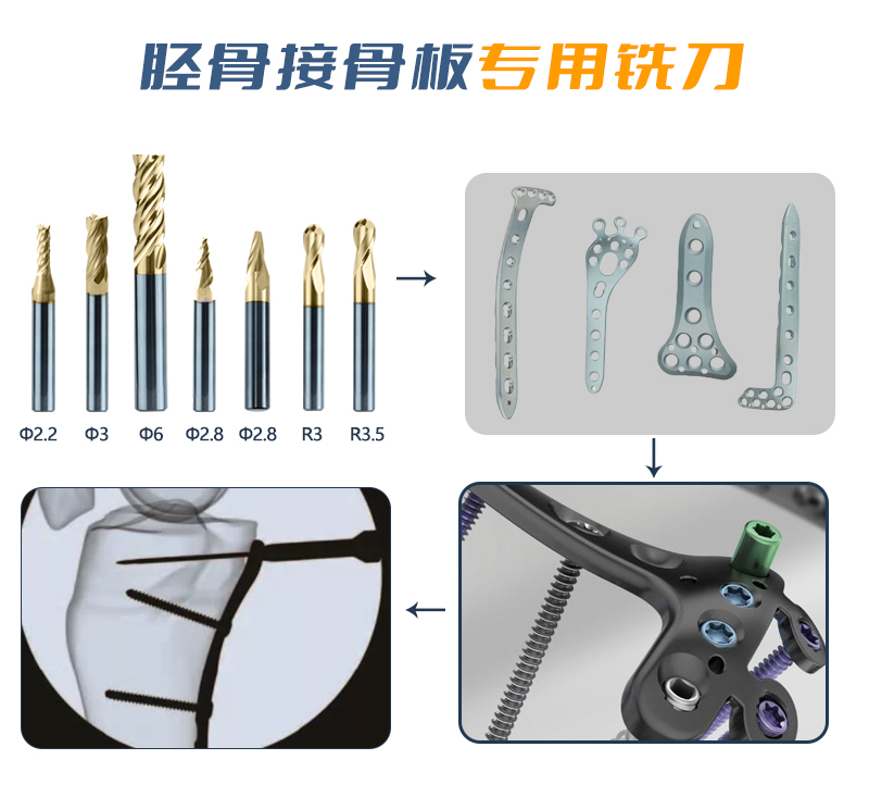 胫骨接骨板 (1) 胫骨接骨板 (1)